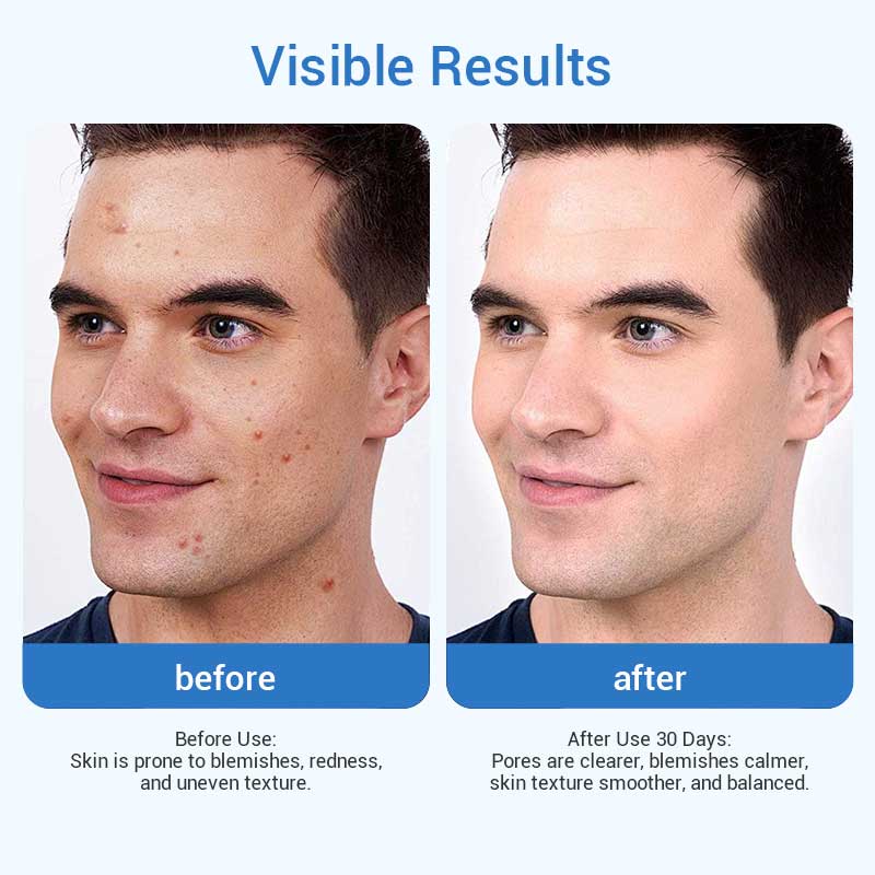 private label men blemish relief serum